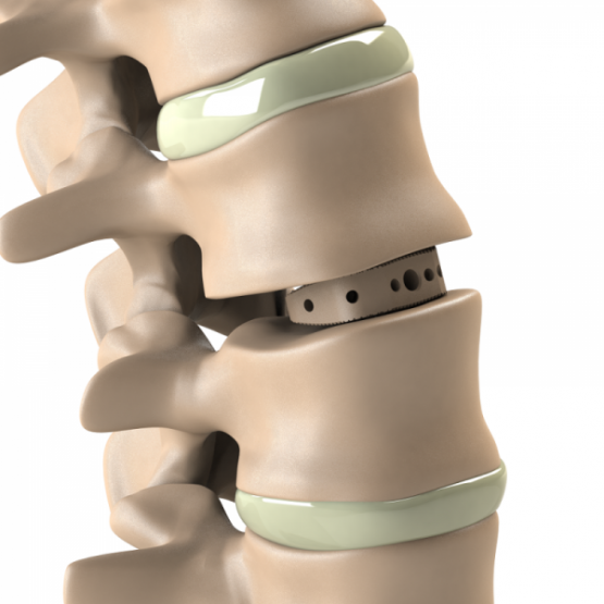 ADITUS LUMBAR ALIF CAGE ADITUS